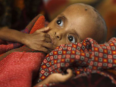 Un niño sufre desnutrición en Chad.