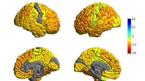 Representación de cerebros con trastorno bipolar