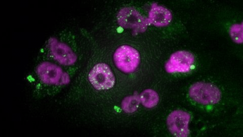 Células tumorales de adenocarcinoma de páncreas que muestran signos de daño en el ADN del núcleo (puntos blancos) y de micronúcleos (en verde), después de un tratamiento con taxol seguido de inhibidores de CDK4/6. /CNIO