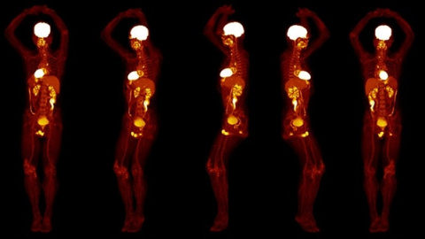 : Varias imágenes de un cuerpo humano completo obtenidas por el nuevo escáner Explorer./UCDAVIS/UNITED IMAGING