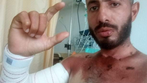 Khaled, en el hospital el día del alta, con un brazo maltrecho arriba y la parte del cuerpo no sumergida quemada por el sol.