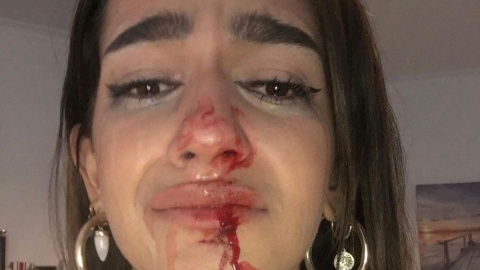 Eva muestra sus heridas tras la agresión tránsfoba. - Twitter de Eva