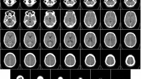 Un grupo de investigadores identifica 75 regiones del genoma asociadas al alzhéimer