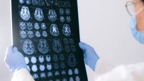 Investigadors del Clínic descobreixen perquè els símptomes de l'Alzheimer són més greus en els pacients més joves