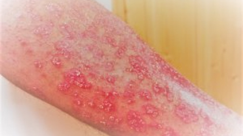 Un juzgado considera la psoriasis como causa de incapacidad permanente