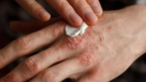 Otras miradas - Psoriasis: la solución está en el sistema inmunitario