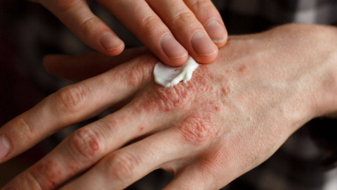 Una mano con lesiones de psoriasis en una foto de archivo.