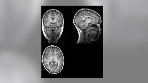 Ejemplo de imagen original de la resonancia magnética a partir de la cual investigadores de la UGR han extraído la cantidad total de materia gris, materia blanca, y cantidad total cerebral - UGR