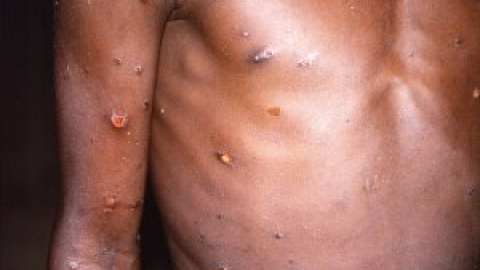 África declara la emergencia de salud pública por el brote de mpox