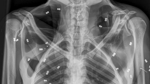 Radiografia del torso de la orangutana./EFE