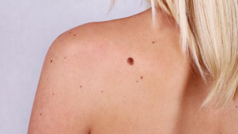 El melanoma es el cáncer de piel menos común pero el que mayor tasa de mortalidad tiene.