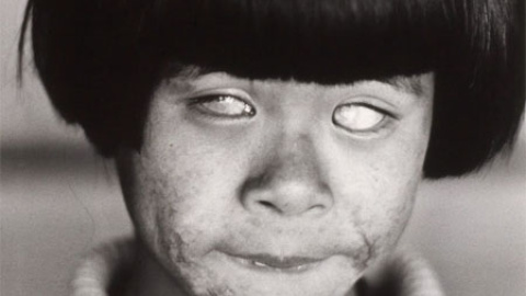 La "niña que vio la luz que brilla como mil soles" en Hiroshima, con la cara y los ojos quemados.