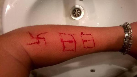 Imagen del brazo del menor tras la agresión por parte de miembros un grupo de extrema derecha.