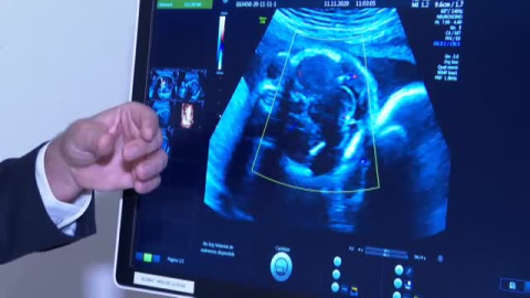 La Fundación La Caixa impulsa el primer gran proyecto europeo de placenta artificial