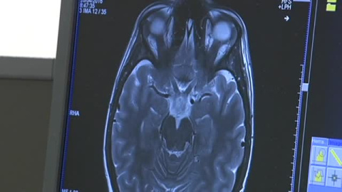 Una pastilla para frenar el tumor cerebral que mató a Seve Ballesteros