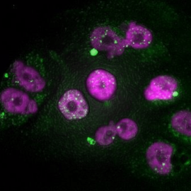 Células tumorales de adenocarcinoma de páncreas que muestran signos de daño en el ADN del núcleo (puntos blancos) y de micronúcleos (en verde), después de un tratamiento con taxol seguido de inhibidores de CDK4/6. /CNIO