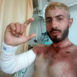 Khaled, en el hospital el día del alta, con un brazo maltrecho arriba y la parte del cuerpo no sumergida quemada por el sol.