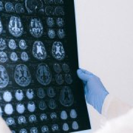 Investigadors del Clínic descobreixen perquè els símptomes de l'Alzheimer són més greus en els pacients més joves