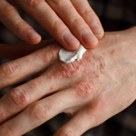 Una mano con lesiones de psoriasis en una foto de archivo.