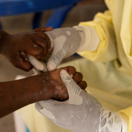 Un enfermero toma una muestra de un niño declarado caso sospechoso de mpox (antes viruela del mono) en un centro de tratamiento en  la provincia de Kivu del Norte, de la República Democrática del Congo. REUTERS/Arlette Bashizi