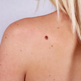 El melanoma es el cáncer de piel menos común pero el que mayor tasa de mortalidad tiene.