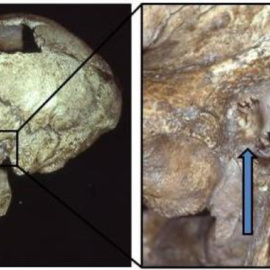 El cráneo de un hombre Neandertal con exóstosis (oído de nadador) / Erik Trinkaus