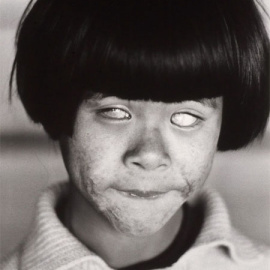 La "niña que vio la luz que brilla como mil soles" en Hiroshima, con la cara y los ojos quemados.