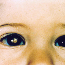 Niño con retinoblastoma/Agencia Sinc